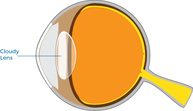 Cataract diagram