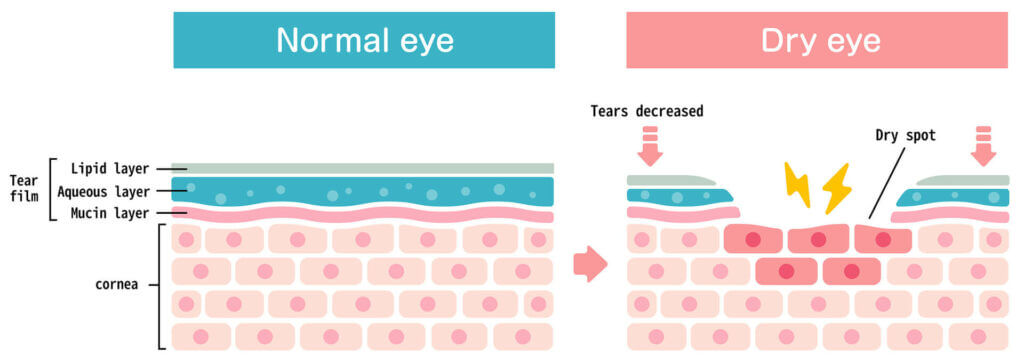 Diagram of normal eye vs dry eye