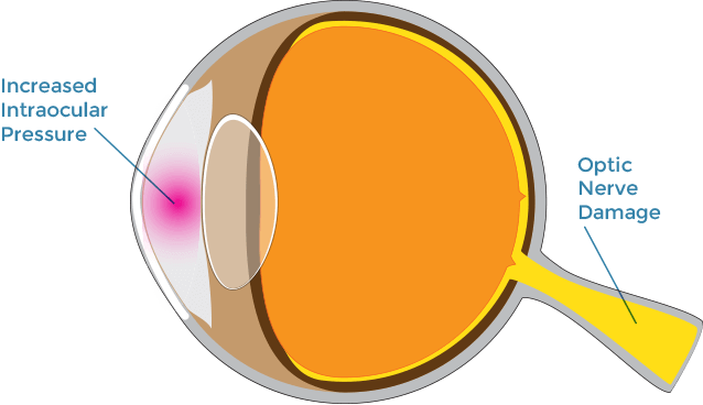 Glaucoma illustration