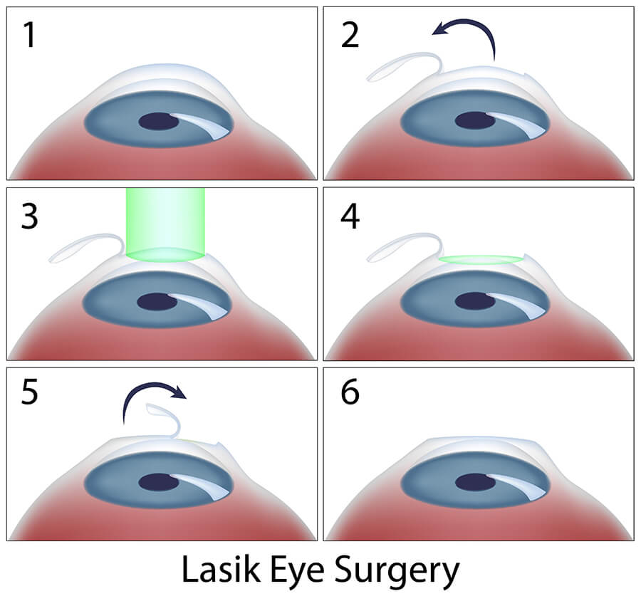 Lasik eye surgery procedure