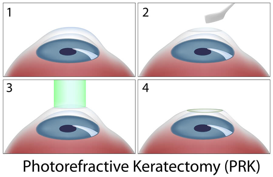 Photorefractive Keratectomy (PRK) surgery